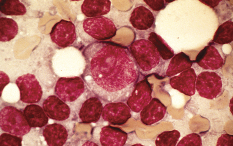 supporting research chronic lymphocytic leukaemia