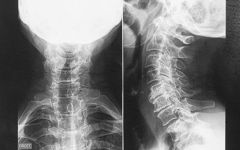supporting research osteoarthritis of the= neck xray