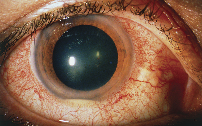 supporting research pus hypopyon in patient eye