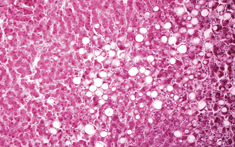 ≈-39-journal-synopsis-fatty-liver-light-micrograph-science-photo-library-c0359428.jpg ≈-39-journal-synopsis-fatty-liver-light-micrograph-science-photo-library-c0359428.jpg