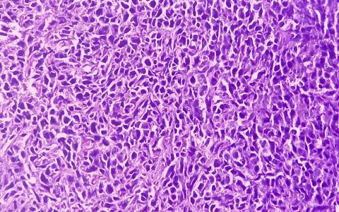 soft tissue sarcoma CREDIT -shutterstock - 2302813459