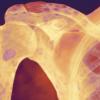 multiple myelomatosis-CREDIT-Science Photo Library-m132099