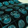 mri examination-CREDIT-istock-1140748315