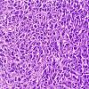 soft tissue sarcoma CREDIT -shutterstock - 2302813459
