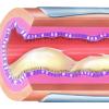 Lungs - Bronchial Mucus Causing Airway Obstruction. credit_istock-174950787