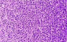 soft tissue sarcoma CREDIT -shutterstock - 2302813459