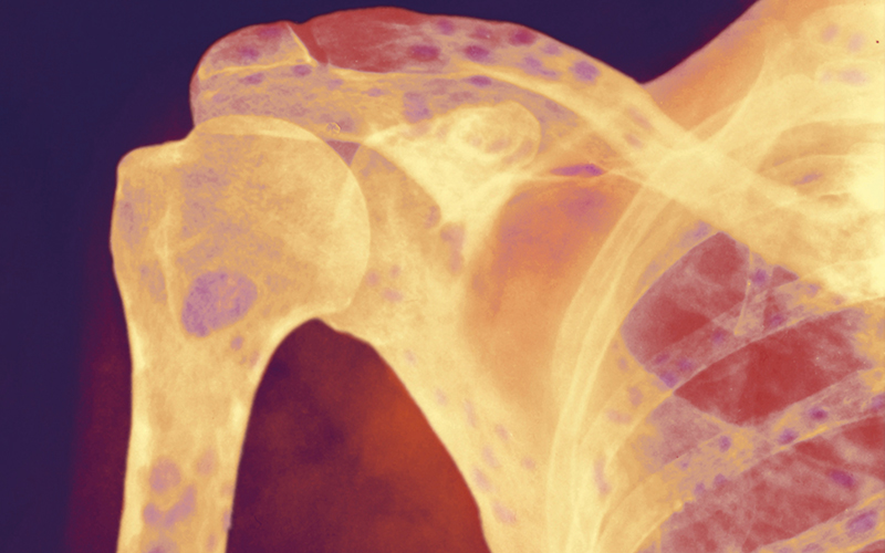 multiple myelomatosis-CREDIT-Science Photo Library-m132099