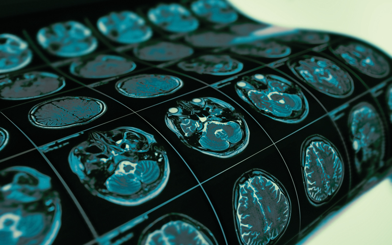mri examination-CREDIT-istock-1140748315