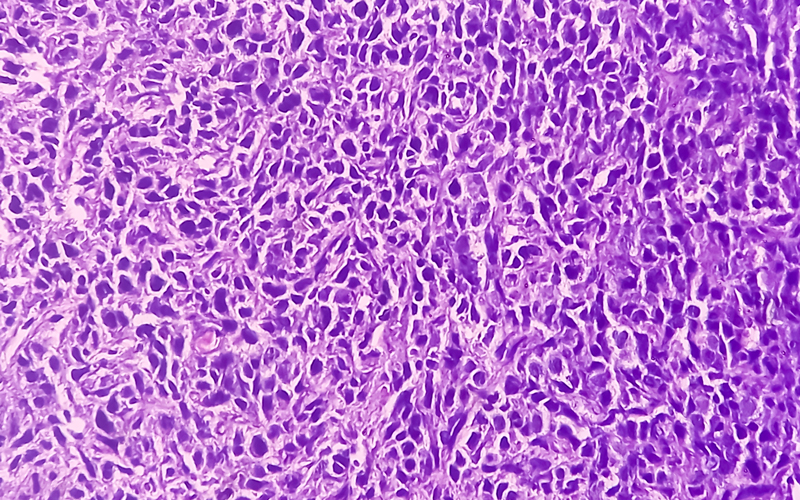 soft tissue sarcoma CREDIT -shutterstock - 2302813459