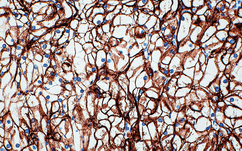 Ccear cell kidney cancer light micrograph -CREDIT - SPlibrary