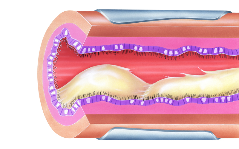 Lungs - Bronchial Mucus Causing Airway Obstruction. credit_istock-174950787